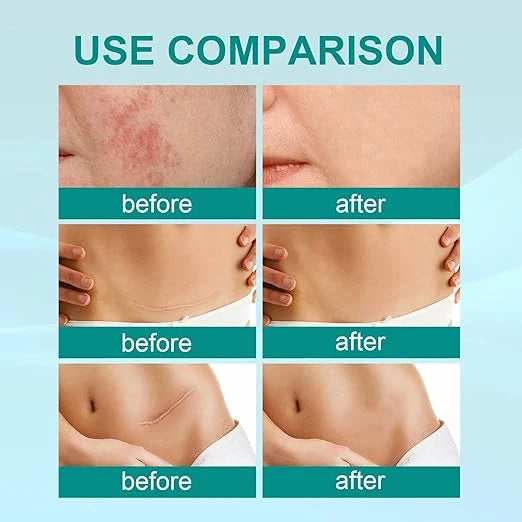 South Moon Scar Spray – Scar Care & Skin Repair Spray